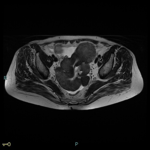 File:Bilateral ovarian fibroma (Radiopaedia 44568-48293 Axial T2 14).jpg