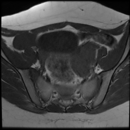 File:Bilateral ovarian fibrothecomas - adolescent (Radiopaedia 86604-102707 Axial T1 11).jpg