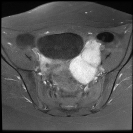 File:Bilateral ovarian fibrothecomas - adolescent (Radiopaedia 86604-102707 Axial T1 C+ fat sat 12).jpg