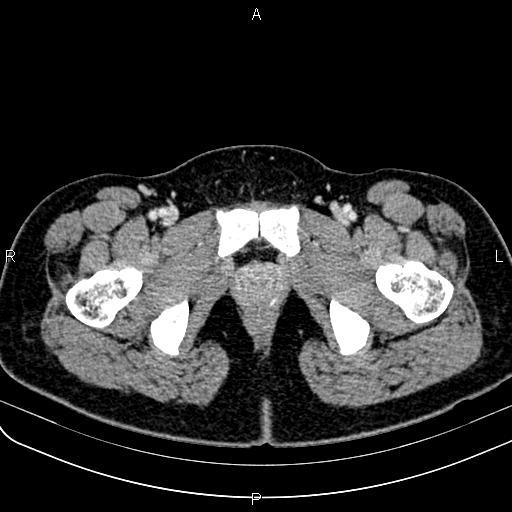 Bilateral ovarian teratoma (Radiopaedia 83131-97503 Axial With contrast 81).jpg