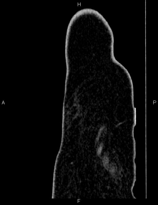 Bilateral ovarian teratoma (Radiopaedia 83131-97503 D 115).jpg