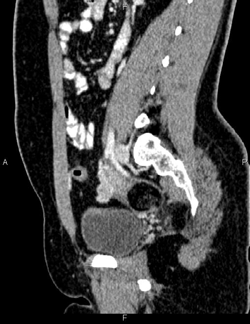 Bilateral ovarian teratoma (Radiopaedia 83131-97503 D 72).jpg