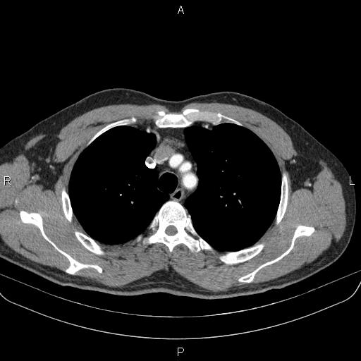 Bilateral pulmonary AVM (Radiopaedia 83134-97505 A 19).jpg