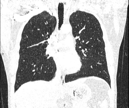 Bilateral pulmonary AVM (Radiopaedia 83134-97505 Coronal lung window 42).jpg