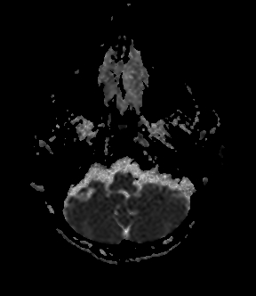 File:Bilateral thalamic glioma (Radiopaedia 65852-75009 Axial ADC 4).jpg