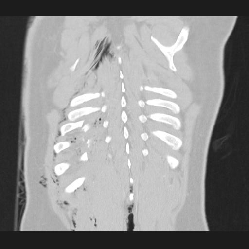 Bilateral traumatic renovascular injury (Radiopaedia 32051-32995 Coronal lung window 72).jpg