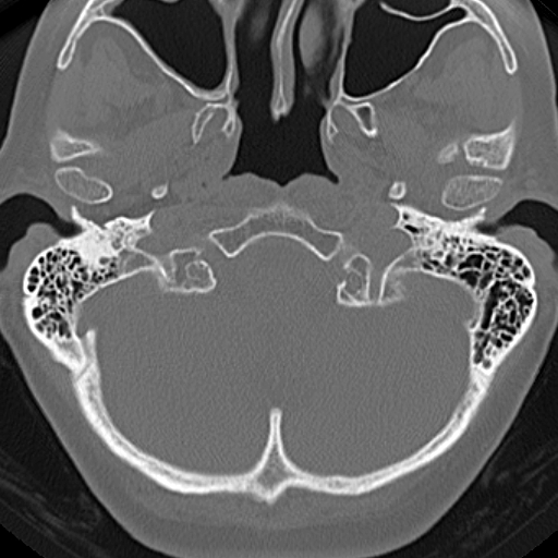 File:Bilateral tympanoplasty (Radiopaedia 16947-16664 Axial bone window 25).jpg