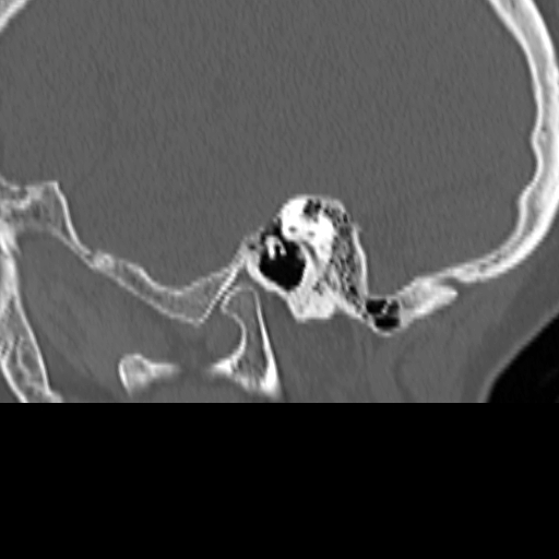 Bilateral tympanoplasty (Radiopaedia 16947-16664 Sagittal bone window 20).jpg