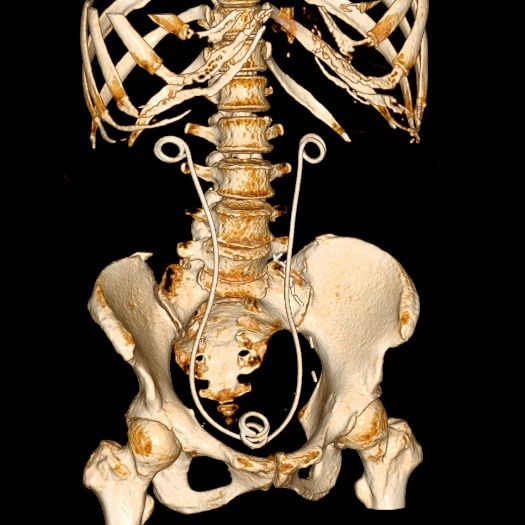 File:Bilateral ureteric stents (Radiopaedia 48795-53825 D 1).jpg