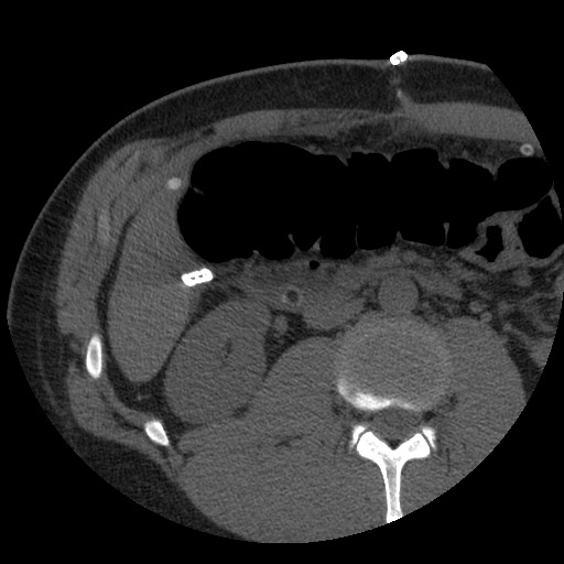 Bile leak from liver traumatic laceration (Radiopaedia 63463-72077 Axial Biliscopin 70).jpg