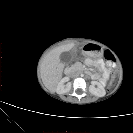 Biliary tract embryonal rhabdomyosarcoma (Radiopaedia 51815-57648 A 58).jpg