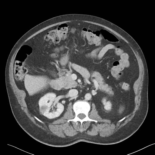 File:Bladder papillary urothelial carcinoma (Radiopaedia 48119-52951 Axial 19).png