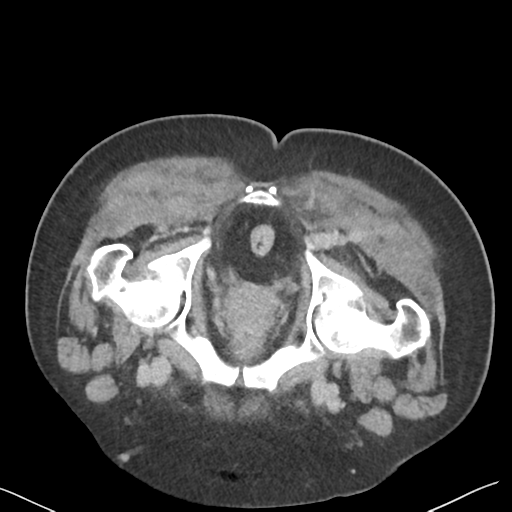 File:Bladder papillary urothelial carcinoma (Radiopaedia 48119-52951 Axial C+ delayed 58).png