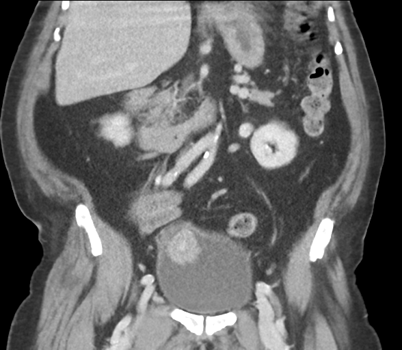 File:Bladder papillary urothelial carcinoma (Radiopaedia 48119-52951 C 35).png