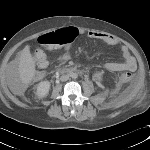 Bladder rupture post renal biopsy (Radiopaedia 30863-31572 Axial non-contrast 47).jpg