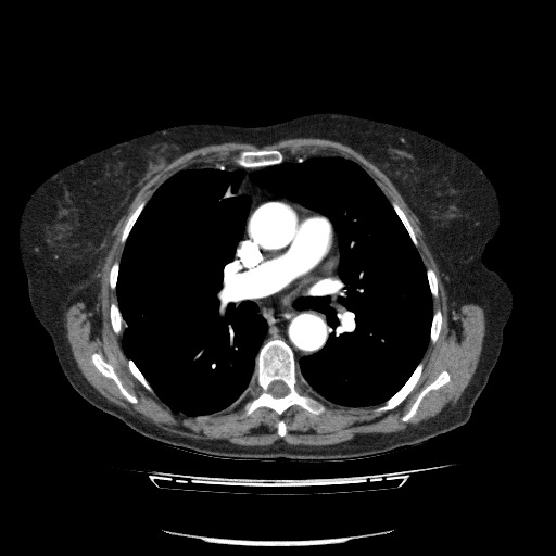 File:Bladder tumor detected on trauma CT (Radiopaedia 51809-57609 A 48).jpg