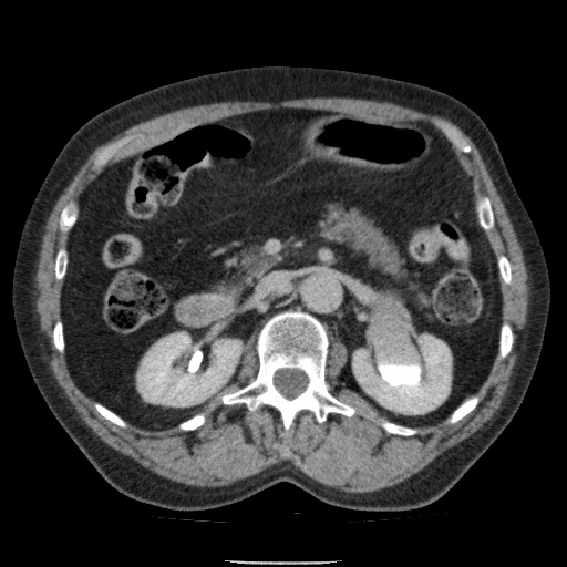 Bladder tumor detected on trauma CT (Radiopaedia 51809-57609 C 50).jpg