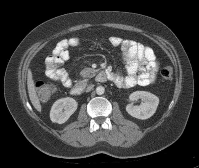 Bleeding duodenal ulcer and adenomyomatosis of gallbladder (Radiopaedia 61834-69861 A 55).jpg