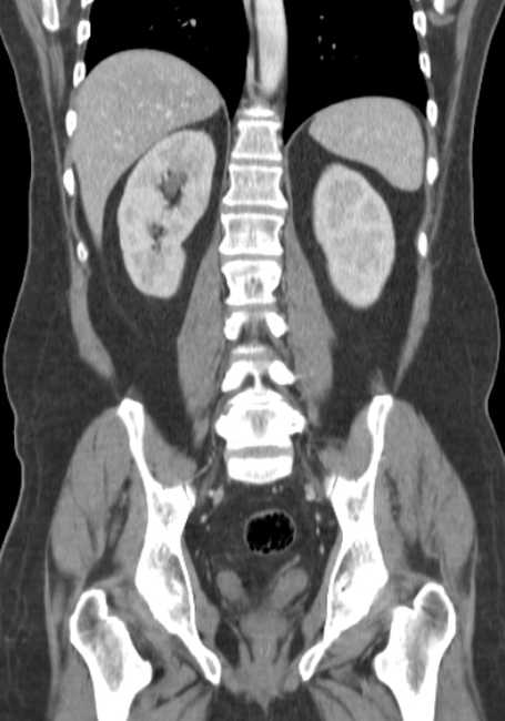 Bleeding duodenal ulcer and adenomyomatosis of gallbladder (Radiopaedia 61834-69861 B 27).jpg