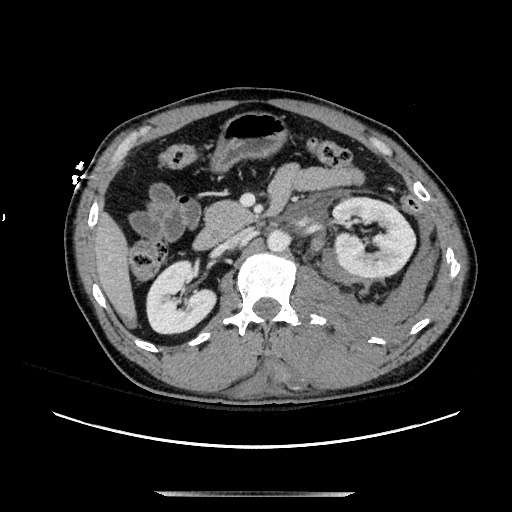 Blunt abdominal trauma with solid organ and musculoskelatal injury with active extravasation (Radiopaedia 68364-77895 A 58).jpg