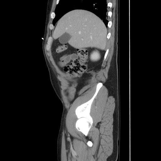 File:Blunt abdominal trauma with solid organ and musculoskelatal injury with active extravasation (Radiopaedia 68364-77895 C 40).jpg