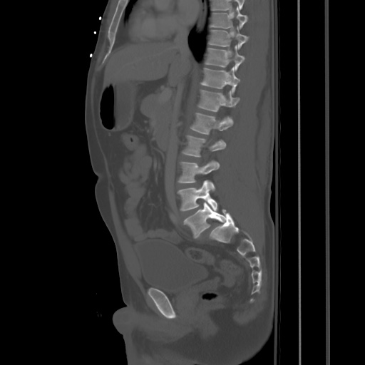 Blunt abdominal trauma with solid organ and musculoskelatal injury with active extravasation (Radiopaedia 68364-77895 Sagittal bone window 45).jpg