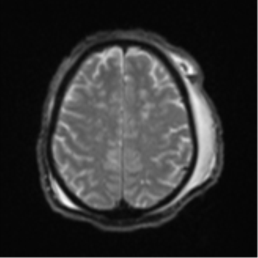 Blunt cerebrovascular injury (Radiopaedia 53682-59745 Axial DWI 23).png