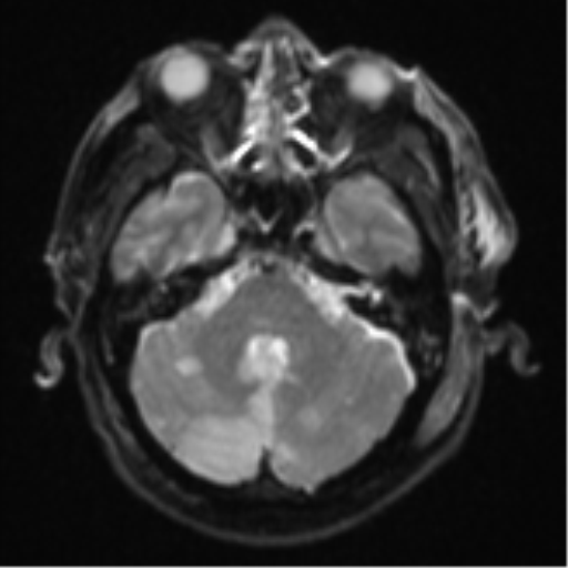 File:Blunt cerebrovascular injury (Radiopaedia 53682-59745 Axial DWI 9).png