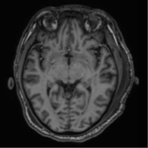 File:Blunt cerebrovascular injury (Radiopaedia 53682-59745 Axial T1 15).png