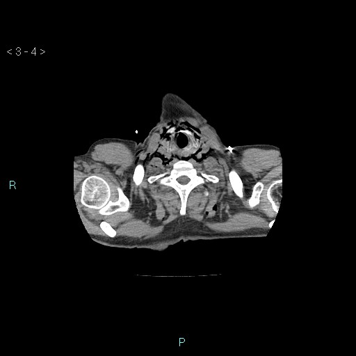 Boerhaave syndrome (Radiopaedia 27683-27897 Axial non-contrast 4).jpg