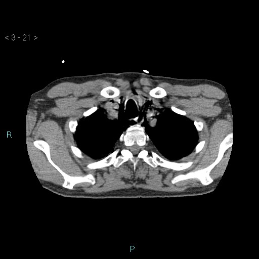 Boerhaave syndrome (Radiopaedia 27683-27897 oral contrast 21).jpg