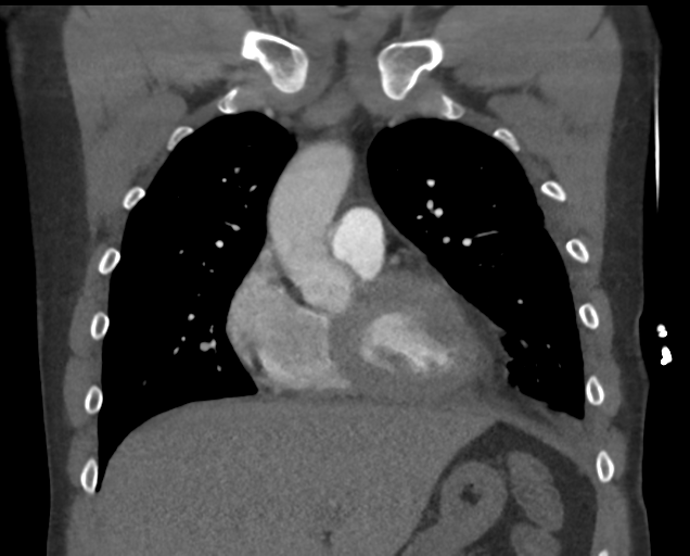 File:Boerhaave syndrome (Radiopaedia 39382-41660 C 32).png