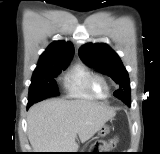 File:Boerhaave syndrome (Radiopaedia 39382-41661 B 14).png
