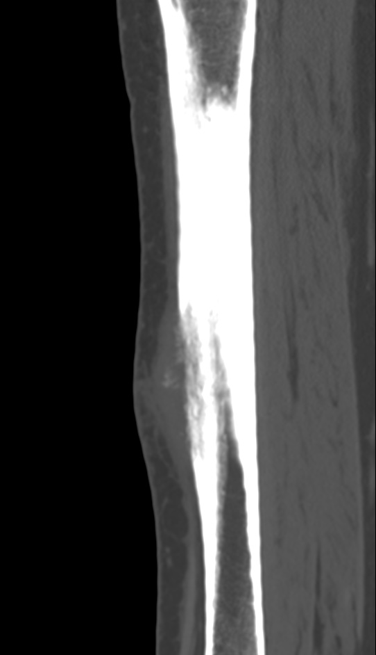 Bone metastasis - tibia (Radiopaedia 57665-64609 Sagittal bone window 97).jpg