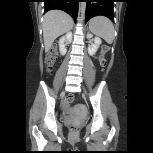 Borderline mucinous tumor (ovary) (Radiopaedia 78228-90808 C 33).jpg