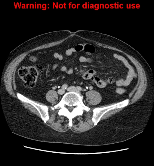 File:Bosniak renal cyst - type II (Radiopaedia 23404-23468 F 41).jpg