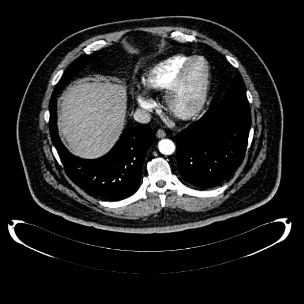 Bosniak renal cyst - type IV (Radiopaedia 24244-24518 B 16).jpg
