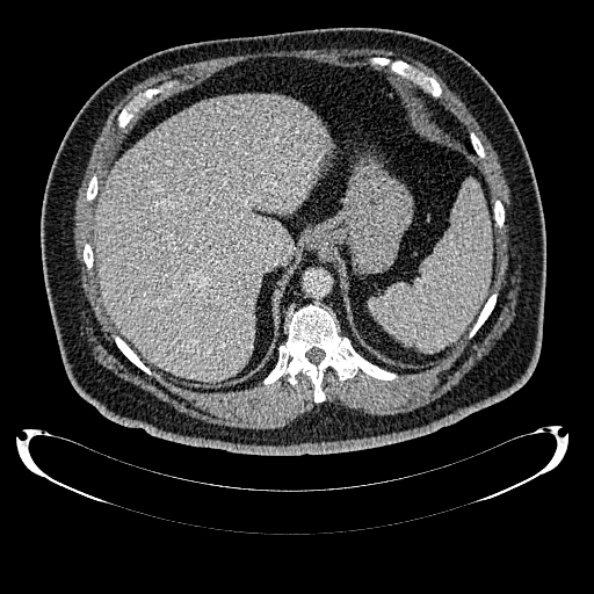 Bosniak renal cyst - type IV (Radiopaedia 24244-24518 C 52).jpg