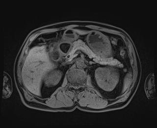 Bouveret syndrome (Radiopaedia 61017-68856 Axial T1 fat sat 33).jpg