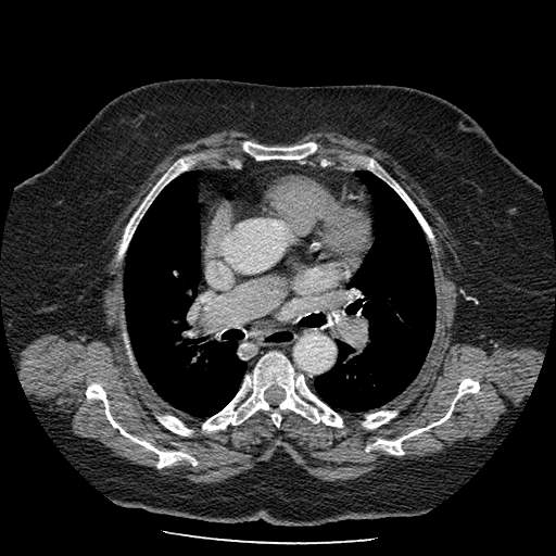 Bovine aortic arch - right internal mammary vein drains into the superior vena cava (Radiopaedia 63296-71875 A 68).jpg