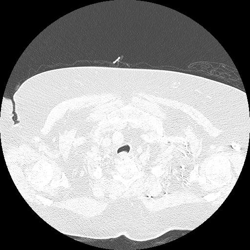 Bovine aortic arch - right internal mammary vein drains into the superior vena cava (Radiopaedia 63296-71875 Axial lung window 15).jpg