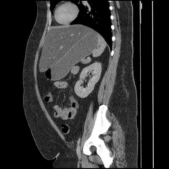File:Bowel and splenic infarcts in acute lymphocytic leukemia (Radiopaedia 61055-68913 C 31).jpg