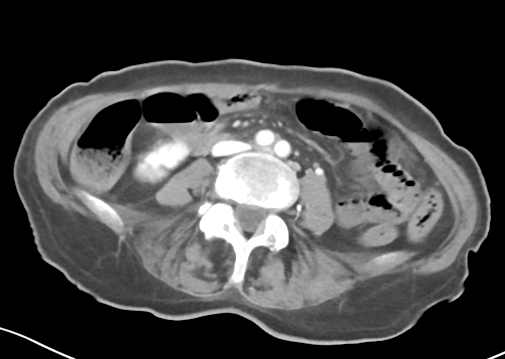 File:Bowel ischemia (Radiopaedia 58273-65382 A 34).png