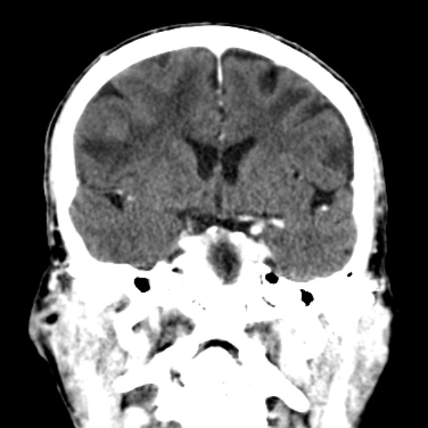 Brain metastases from lung cancer (Radiopaedia 27849-28092 Coronal C+ delayed 30).jpg