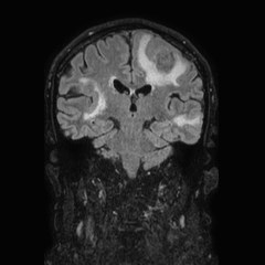 File:Brain metastases from lung cancer (Radiopaedia 83839-99028 Coronal FLAIR 46).jpg
