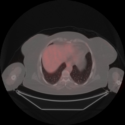 Brain metastasis (Radiopaedia 89847-106962 Axial lung window 48).jpg