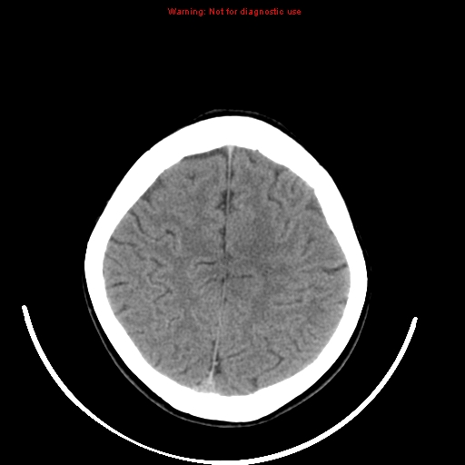 File:Brainstem glioma (Radiopaedia 9444-10123 non-contrast 20).jpg