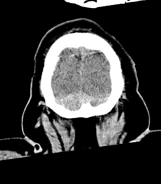 Brainstem hemorrhage (Radiopaedia 81294-94976 Coronal non-contrast 62).jpg