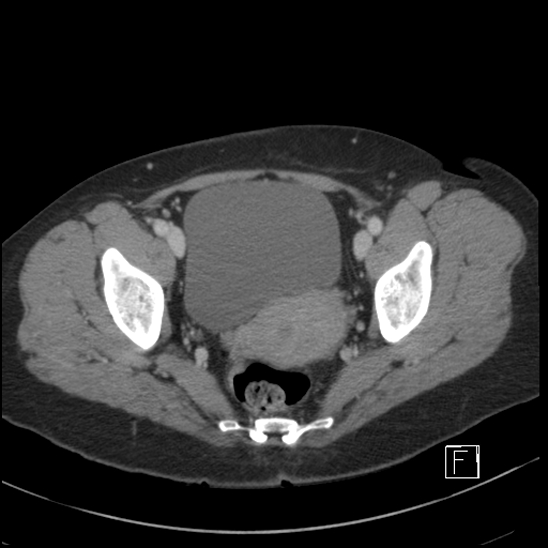 File:Breast metastases from renal cell cancer (Radiopaedia 79220-92225 C 104).jpg