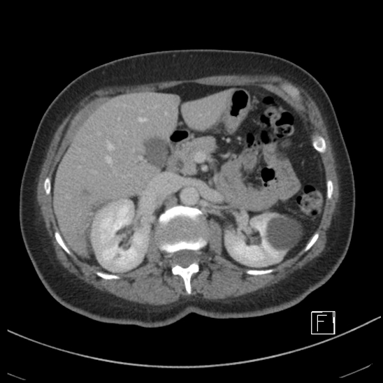 Breast metastases from renal cell cancer (Radiopaedia 79220-92225 C 32).jpg